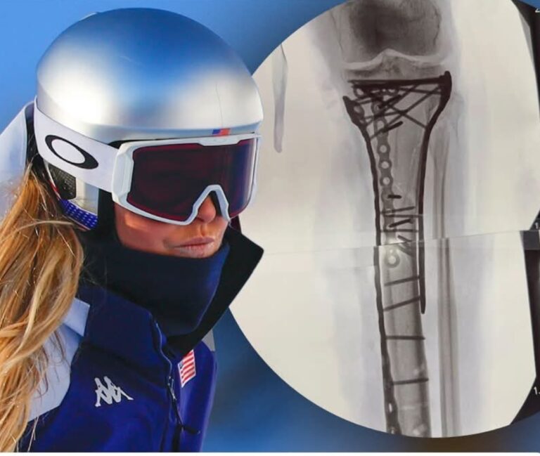 Lindsey Vonn’s Raw Post-Op Battle: 6-Hour Surgery Loaded with Plates & Screws – “Struggling” But “Baby Steps”