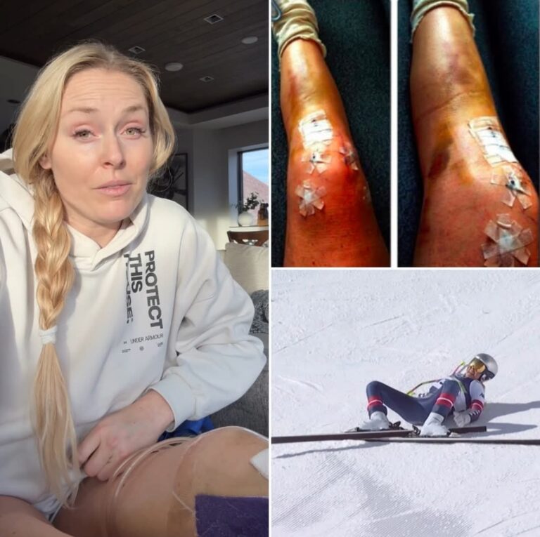 Lindsey Vonn’s Olympic Nightmare: Brutal Crash Shatters Leg, Sparks Talk of Yet Another Surgery