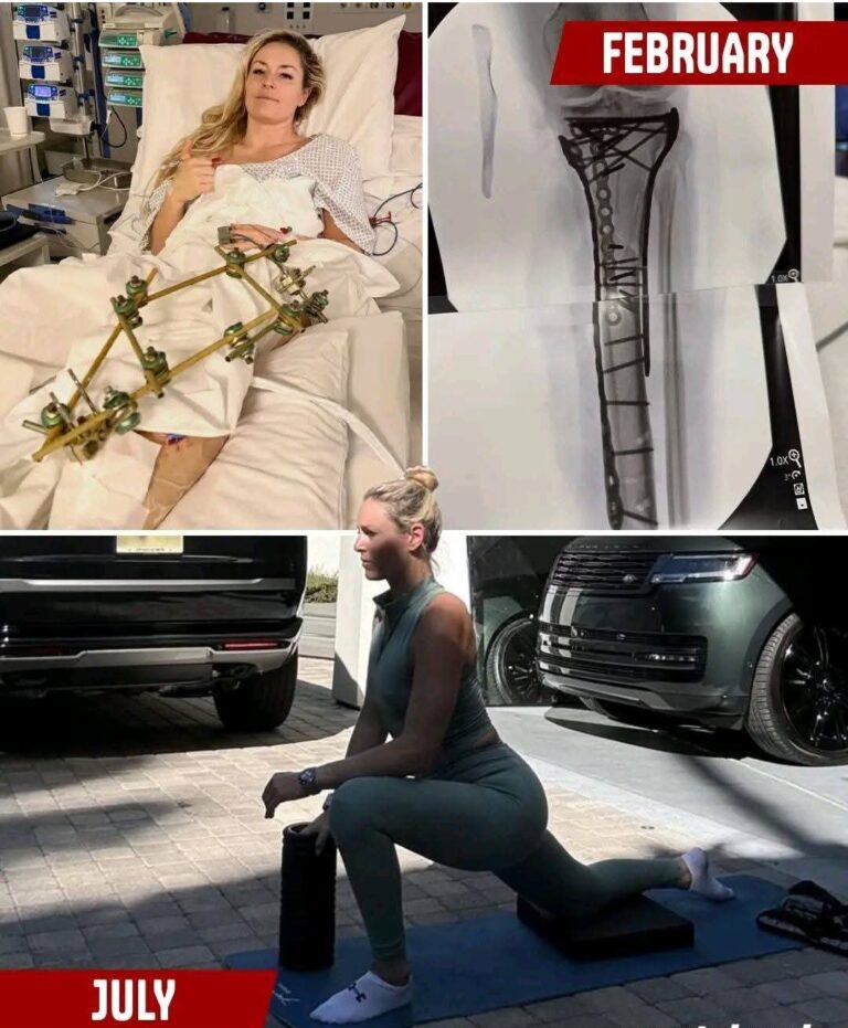 From Hospital Bed to Barbell: Lindsey Vonn’s Insane Recovery Proves She’s the Toughest Olympian Alive